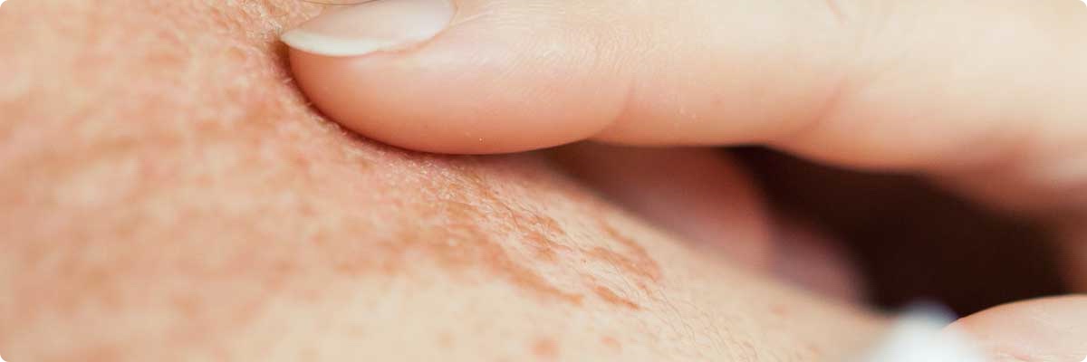 dry skin conditions